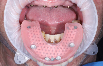 03 Snímateľné náhrady na lokátoroch