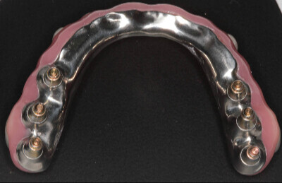 03_Titanovy_strmen_a_ kompozitne_zuby