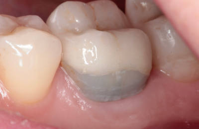 inlay_onlay_overlay_01