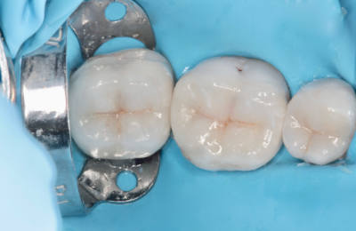 inlay_onlay_overlay_02