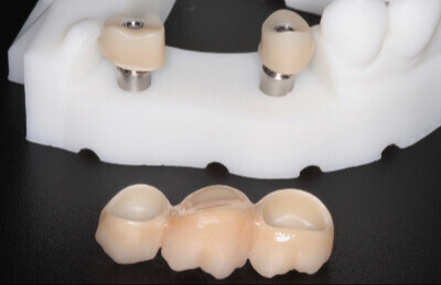 Titanový abutment HappyDent Lab