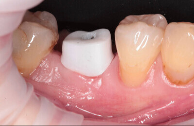 Titanový abutment HappyDent Lab