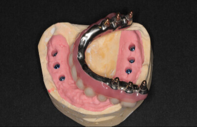 Titánový strmeň a kompozitné zuby