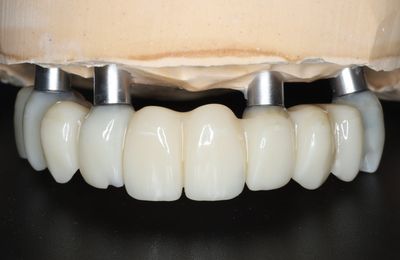 Dočasné konštrukcie, HAPPYDENT LAB