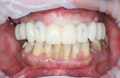 Dočasné konštrukcie, HAPPYDENT LAB