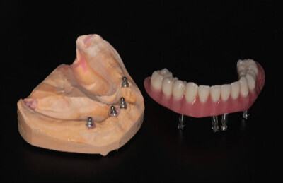 Gulickovy system, mini implantaty