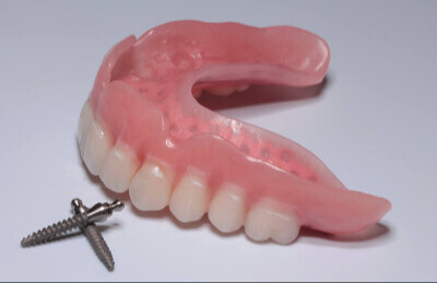 Gulickovy system, mini implantaty